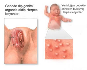 Herpes testi nasıl yapılır genital Genital Herpes